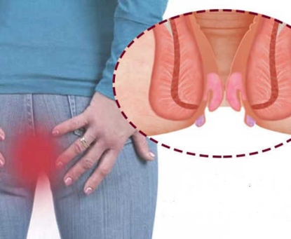 Những triệu chứng giúp nhận biết sớm bệnh trĩ